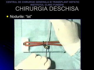 CHIRURGIA DESCHISA Nodurile: “lat” CENTRUL DE CHIRURGIE GENERALA SI TRANSPLANT HEPATIC  INSTITUTUL CLINIC FUNDENI 