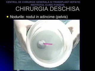 CHIRURGIA DESCHISA Nodurile: nodul in adincime (pelvis) CENTRUL DE CHIRURGIE GENERALA SI TRANSPLANT HEPATIC  INSTITUTUL CLINIC FUNDENI 