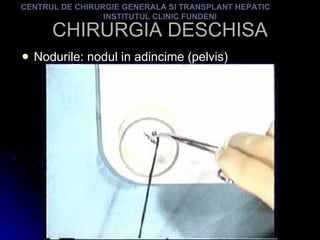 CHIRURGIA DESCHISA Nodurile: nodul in adincime (pelvis) CENTRUL DE CHIRURGIE GENERALA SI TRANSPLANT HEPATIC  INSTITUTUL CLINIC FUNDENI 
