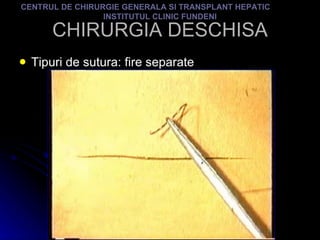 CHIRURGIA DESCHISA Tipuri de sutura: fire separate CENTRUL DE CHIRURGIE GENERALA SI TRANSPLANT HEPATIC  INSTITUTUL CLINIC FUNDENI 