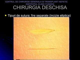 CHIRURGIA DESCHISA Tipuri de sutura: fire separate (incizie eliptica) CENTRUL DE CHIRURGIE GENERALA SI TRANSPLANT HEPATIC  INSTITUTUL CLINIC FUNDENI 