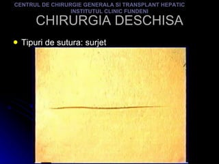 CHIRURGIA DESCHISA Tipuri de sutura: surjet CENTRUL DE CHIRURGIE GENERALA SI TRANSPLANT HEPATIC  INSTITUTUL CLINIC FUNDENI 