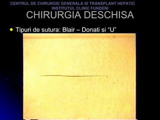 CHIRURGIA DESCHISA Tipuri de sutura: Blair – Donati si “U” CENTRUL DE CHIRURGIE GENERALA SI TRANSPLANT HEPATIC  INSTITUTUL CLINIC FUNDENI 