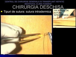 CHIRURGIA DESCHISA Tipuri de sutura: sutura intradermica CENTRUL DE CHIRURGIE GENERALA SI TRANSPLANT HEPATIC  INSTITUTUL CLINIC FUNDENI FIR SPECIAL DE SUTURA INTRADERMICA 