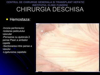 CHIRURGIA DESCHISA Hemostaza: CENTRUL DE CHIRURGIE GENERALA SI TRANSPLANT HEPATIC  INSTITUTUL CLINIC FUNDENI -Incizia peritoneului -Izolarea pediculului vascular -Pensarea cu ajutorula 2 pense Pean a ambelor capete -Sectionarea intre pense a vasului -Ligaturarea capetelo 
