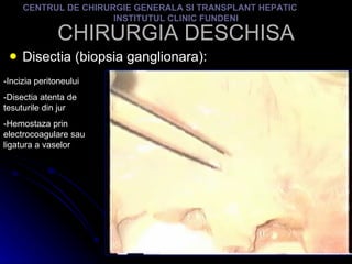 CHIRURGIA DESCHISA Disectia (biopsia ganglionara): CENTRUL DE CHIRURGIE GENERALA SI TRANSPLANT HEPATIC  INSTITUTUL CLINIC FUNDENI -Incizia peritoneului -Disectia atenta de tesuturile din jur -Hemostaza prin electrocoagulare sau ligatura a vaselor 