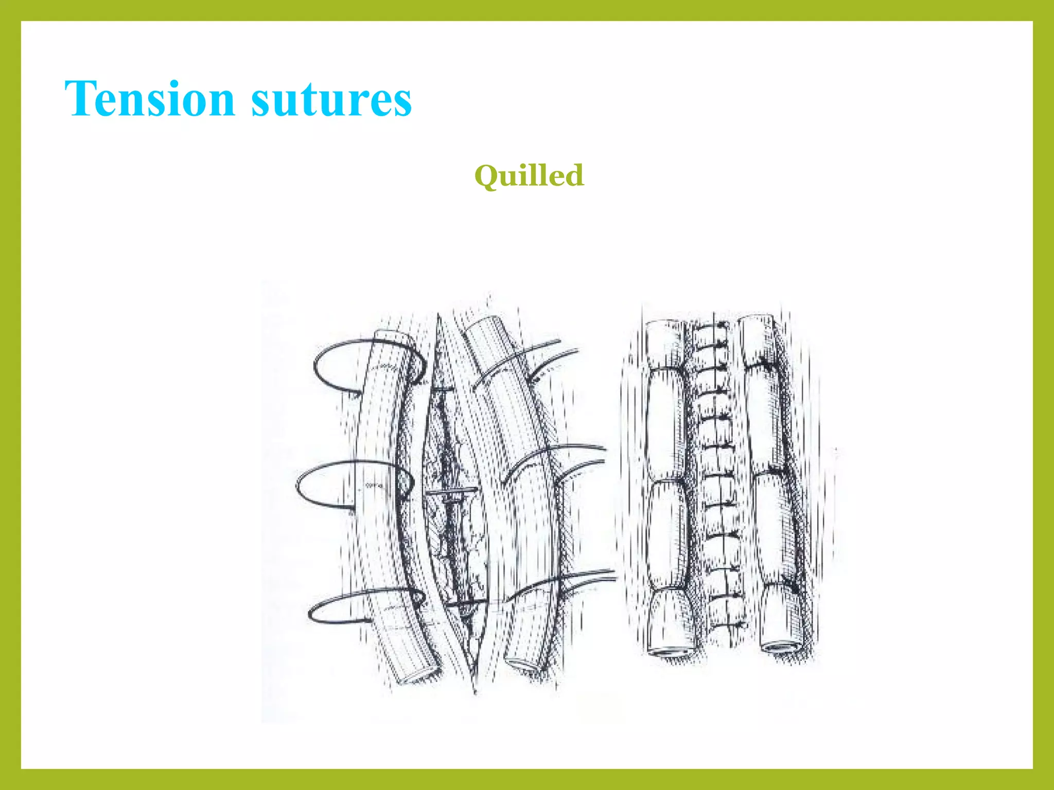 Tension sutures
Quilled
 