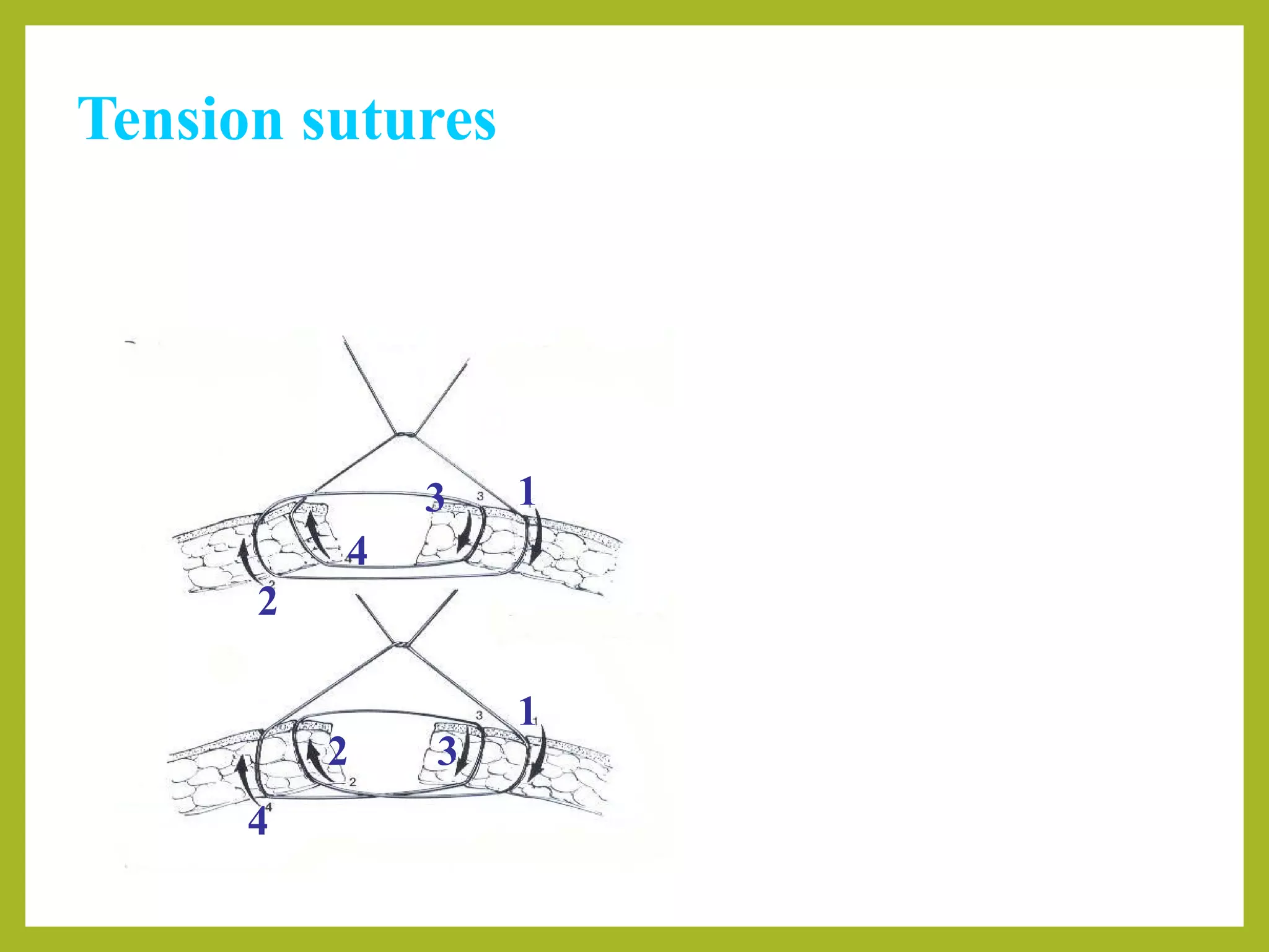 Tension sutures
1
2
3
4
1
2 3
4
Far-far-near-near
Far-near-near-far
 