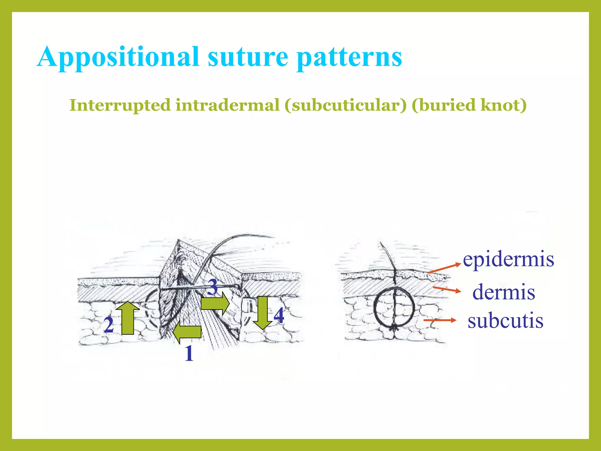 Appositional suture patterns
Interrupted intradermal (subcuticular) (buried knot)
epidermis
dermis
subcutis
1
2
3
4
 