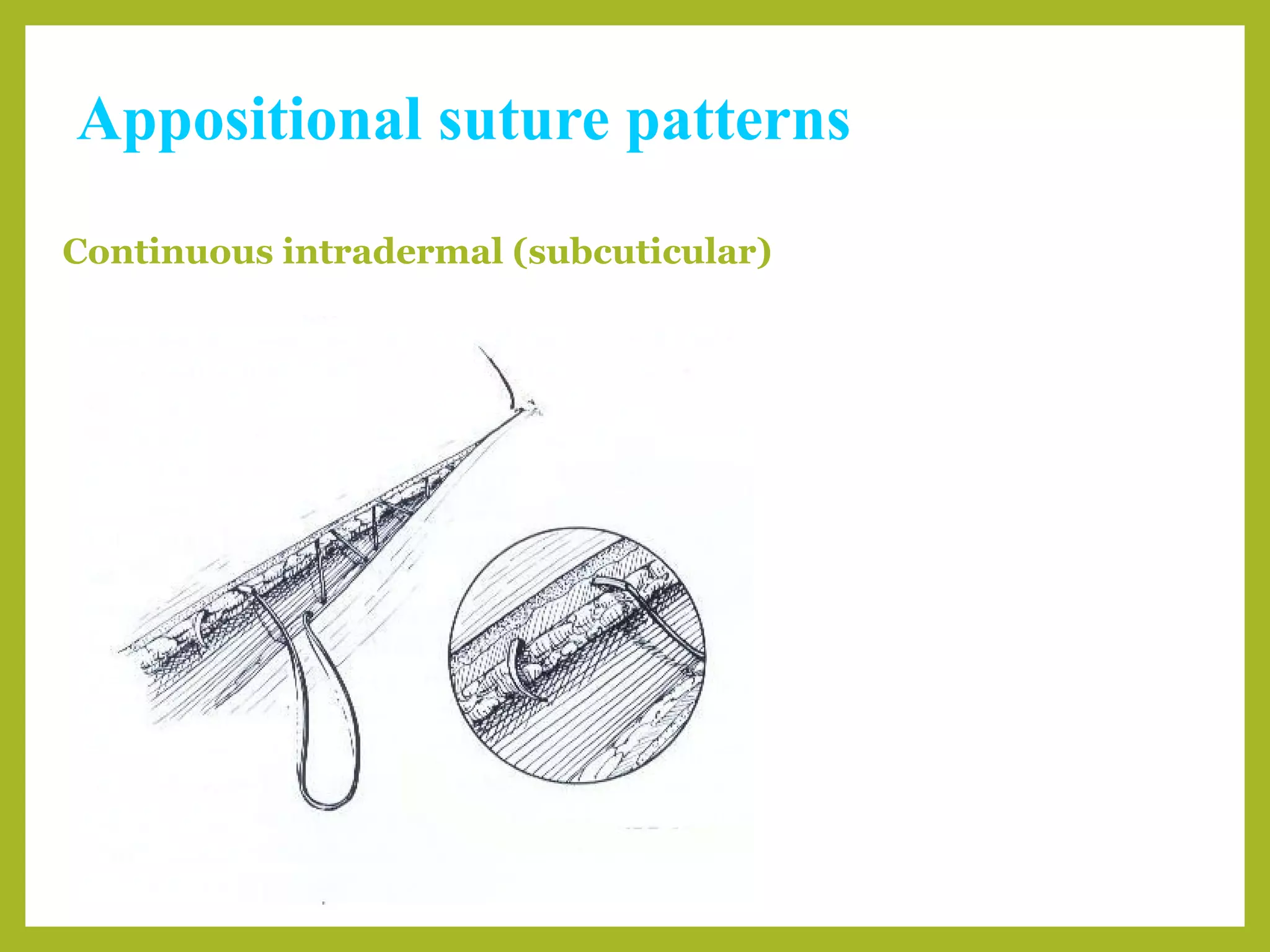 Appositional suture patterns
Continuous intradermal (subcuticular)
 