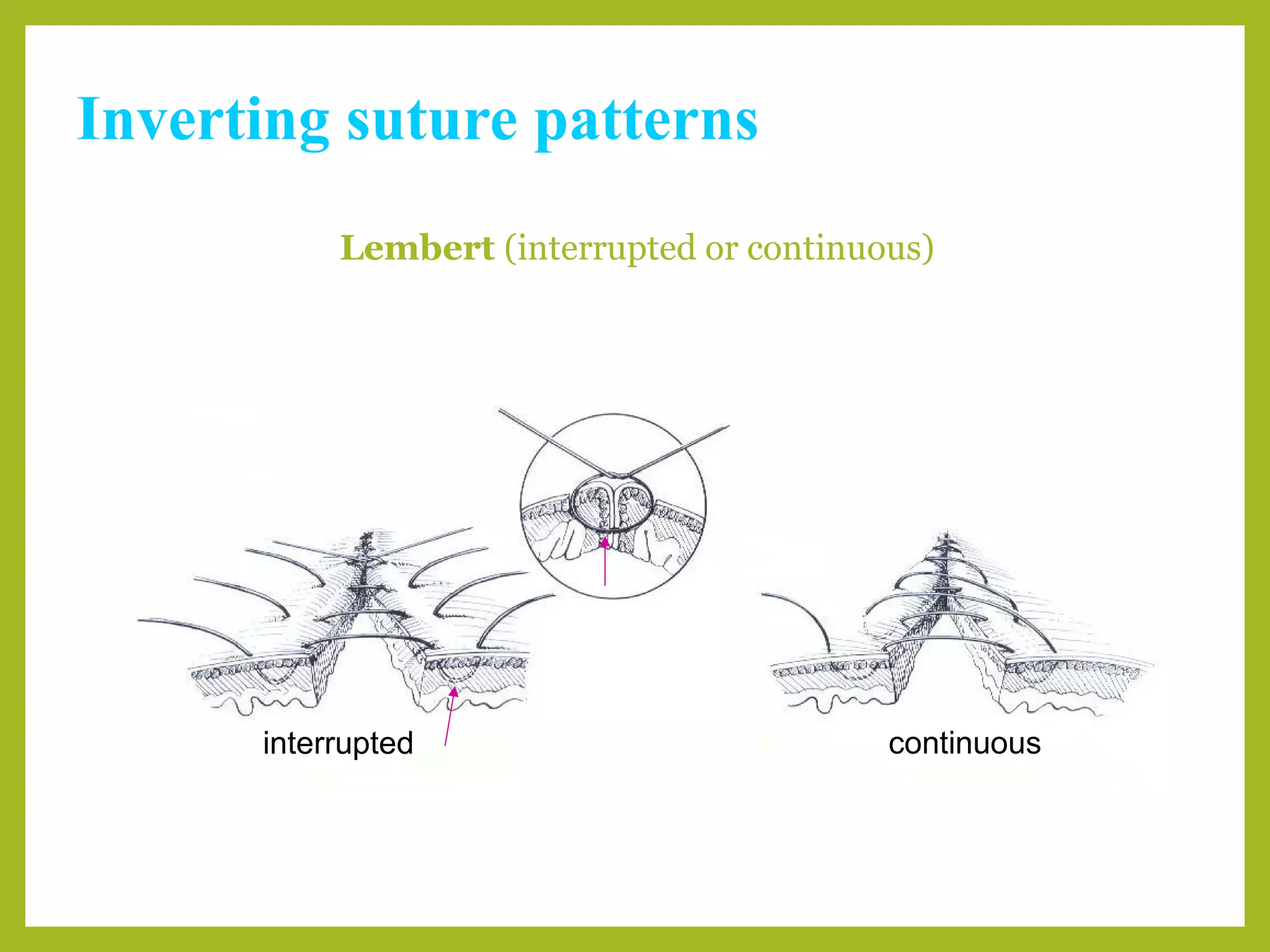 Inverting suture patterns
Lembert (interrupted or continuous)
interrupted continuous
 