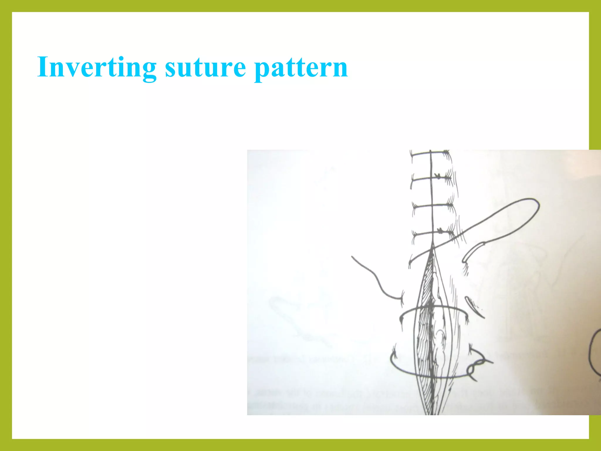Inverting suture pattern
Interrupted inverting mattress
 