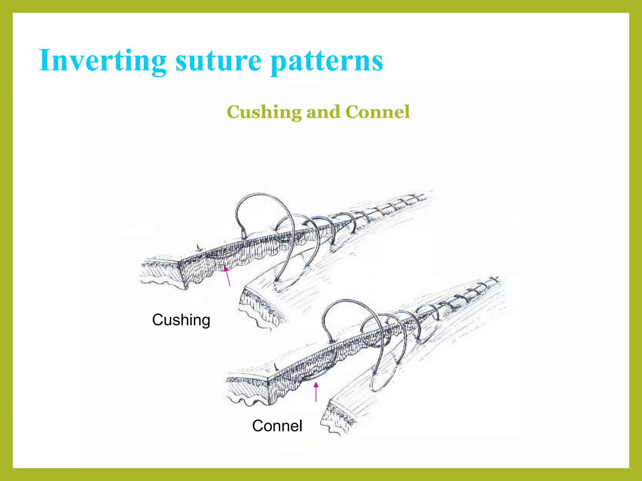 Inverting suture patterns
Cushing and Connel
Cushing
Connel
 