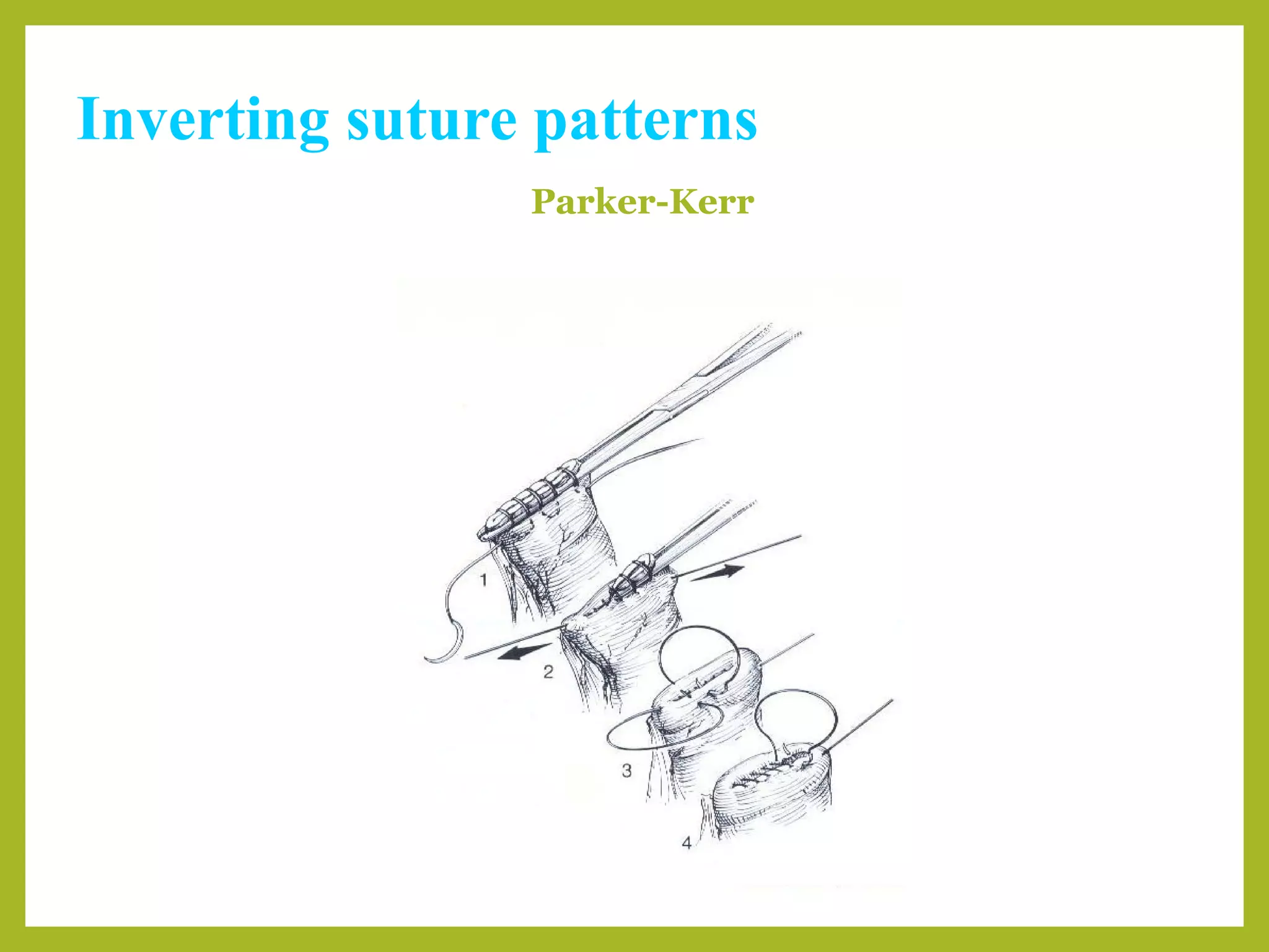 Inverting suture patterns
Parker-Kerr
 