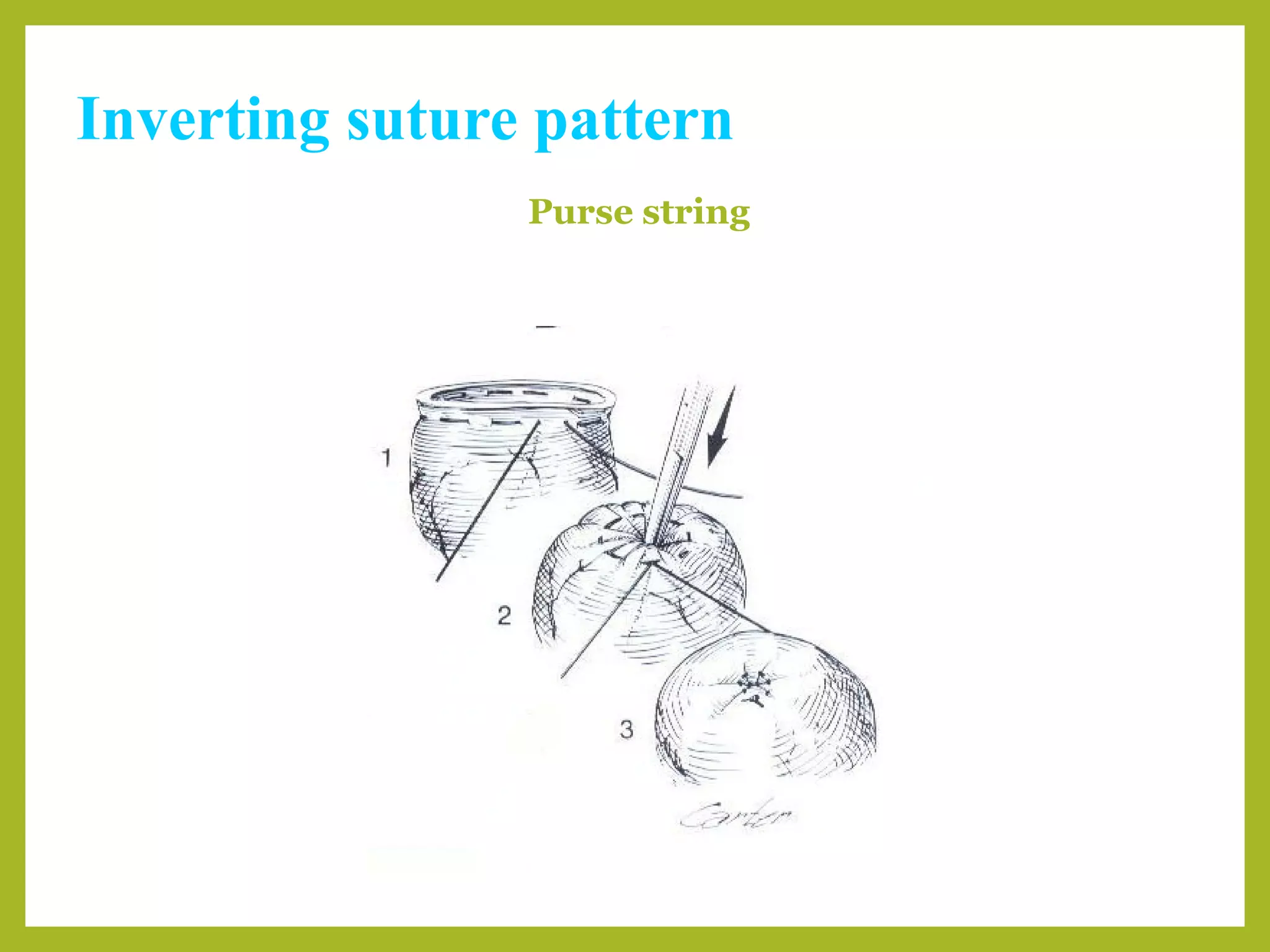 Inverting suture pattern
Purse string
 