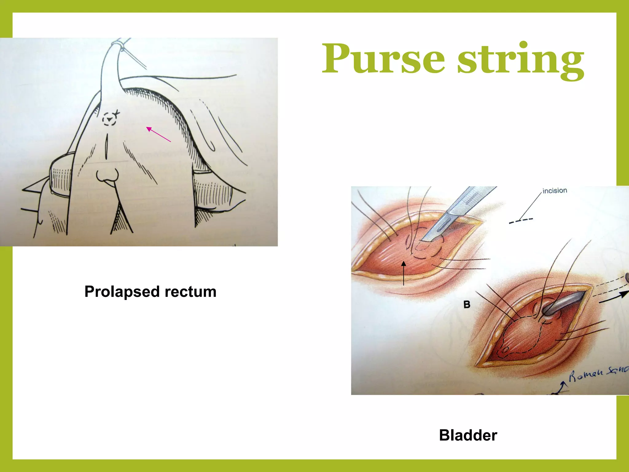 Purse string
Prolapsed rectum
Bladder
 