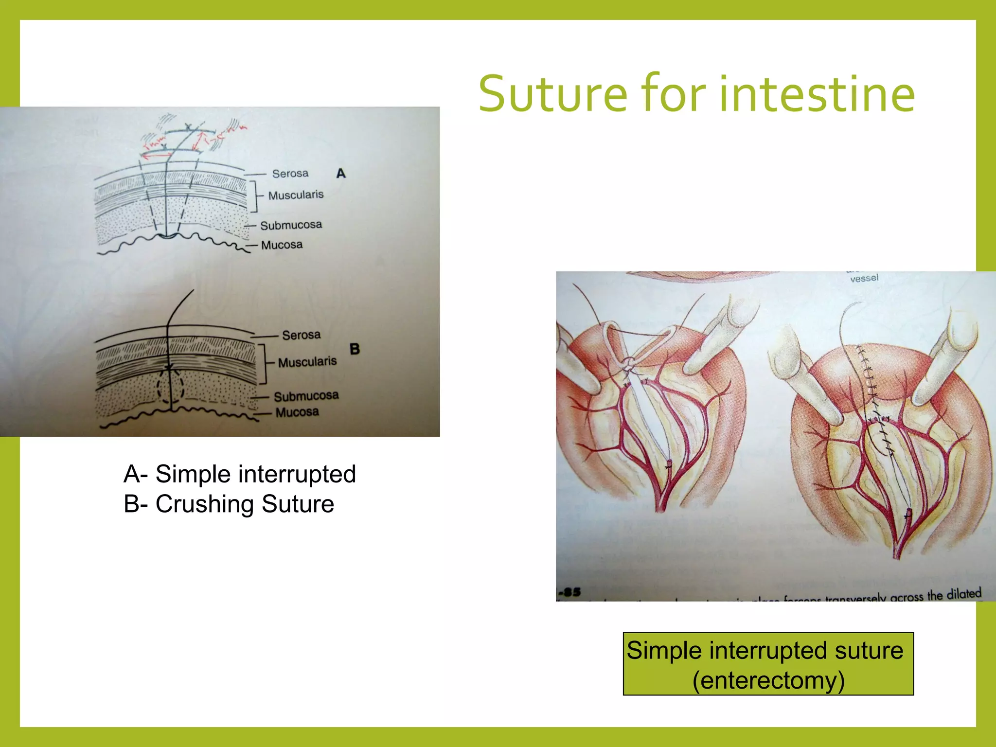 Suture for intestine
A- Simple interrupted
B- Crushing Suture
Simple interrupted suture
(enterectomy)
 