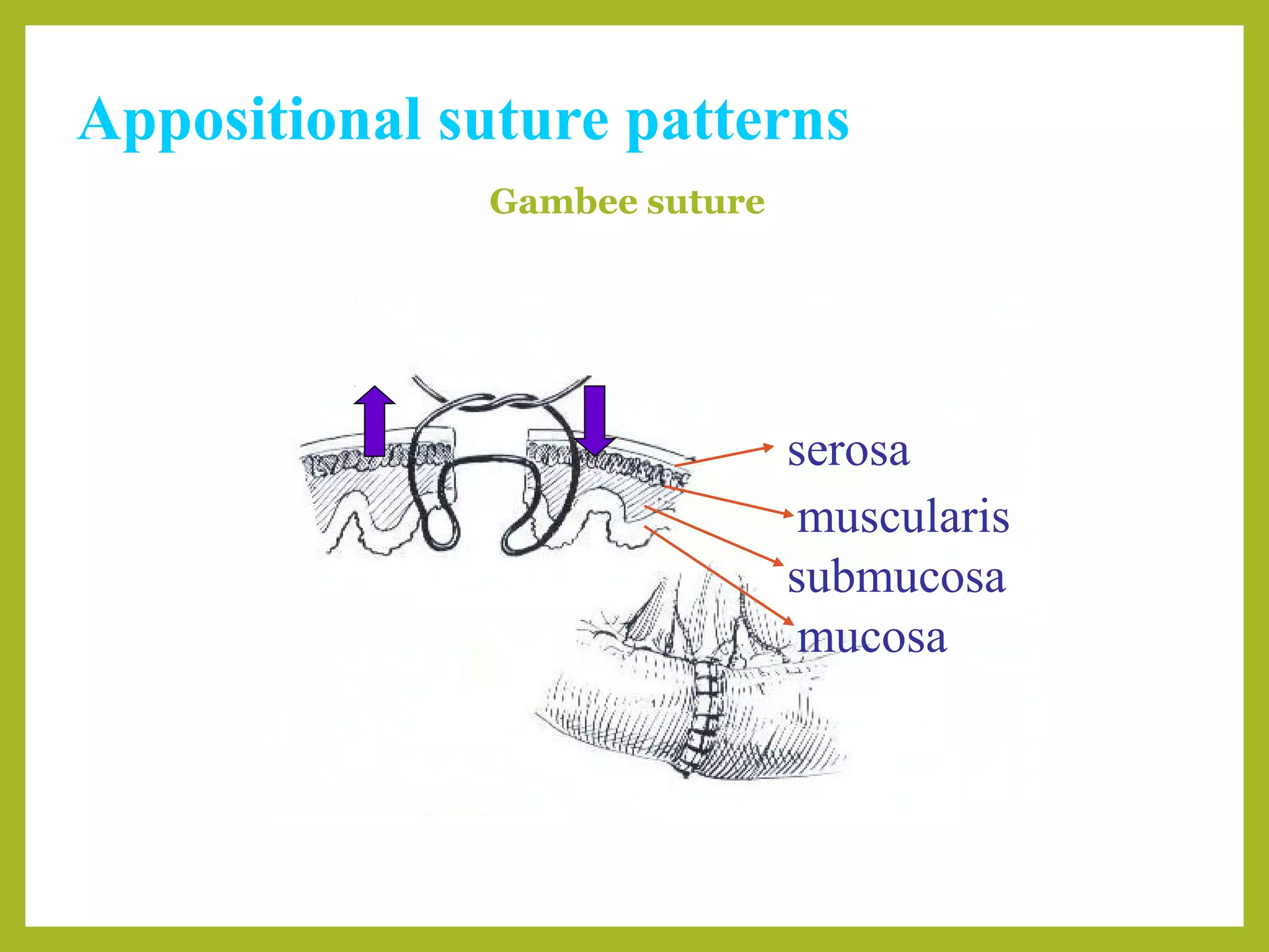 Appositional suture patterns
Gambee suture
serosa
muscularis
submucosa
mucosa
 