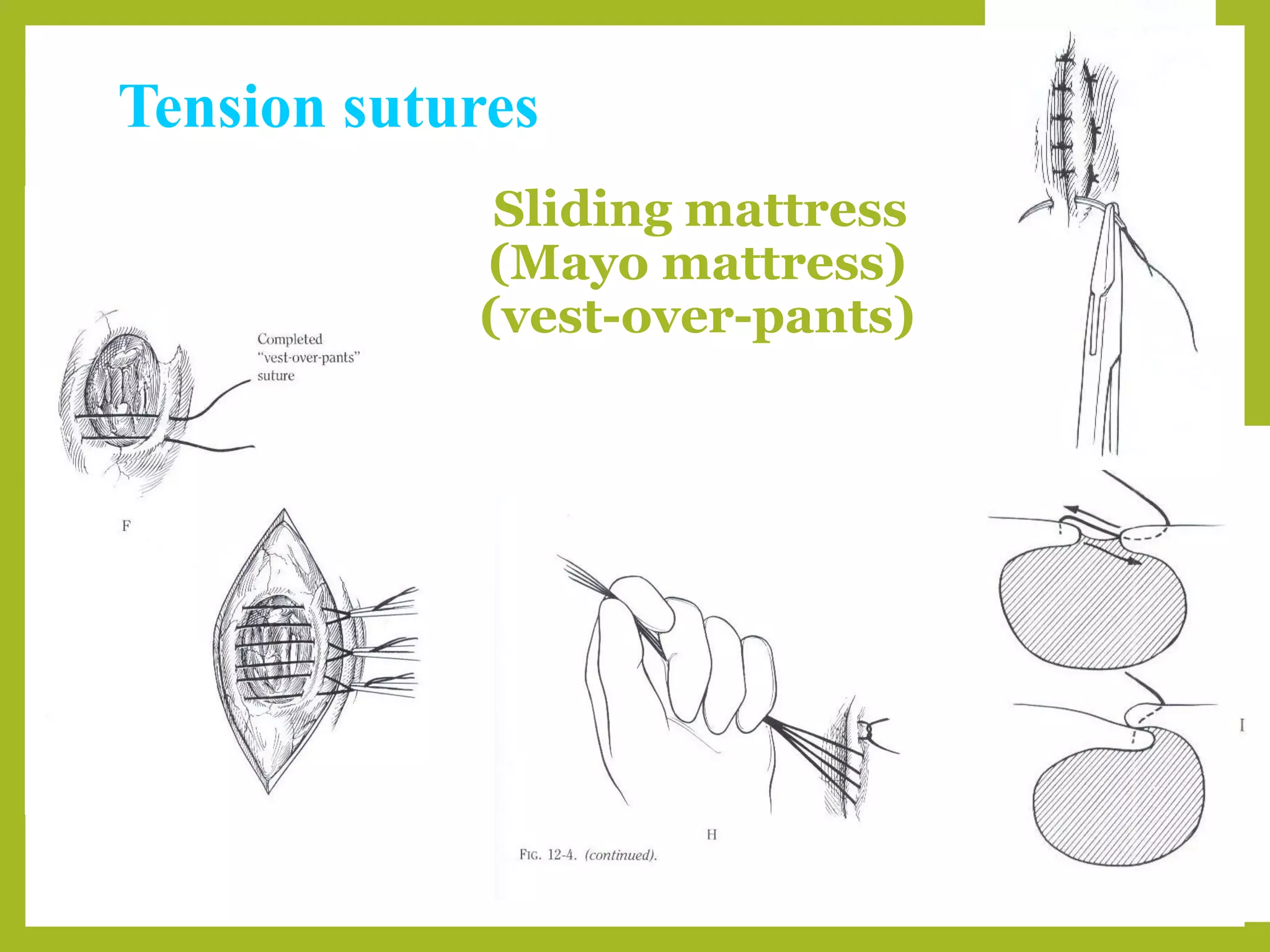 Tension sutures
Sliding mattress
(Mayo mattress)
(vest-over-pants)
 