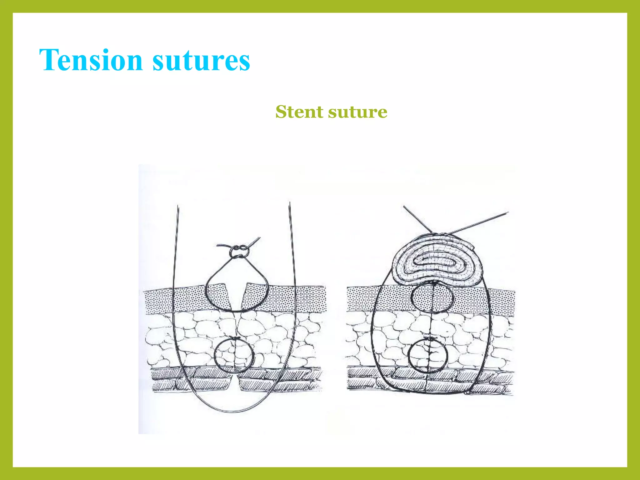 Tension sutures
Stent suture
 