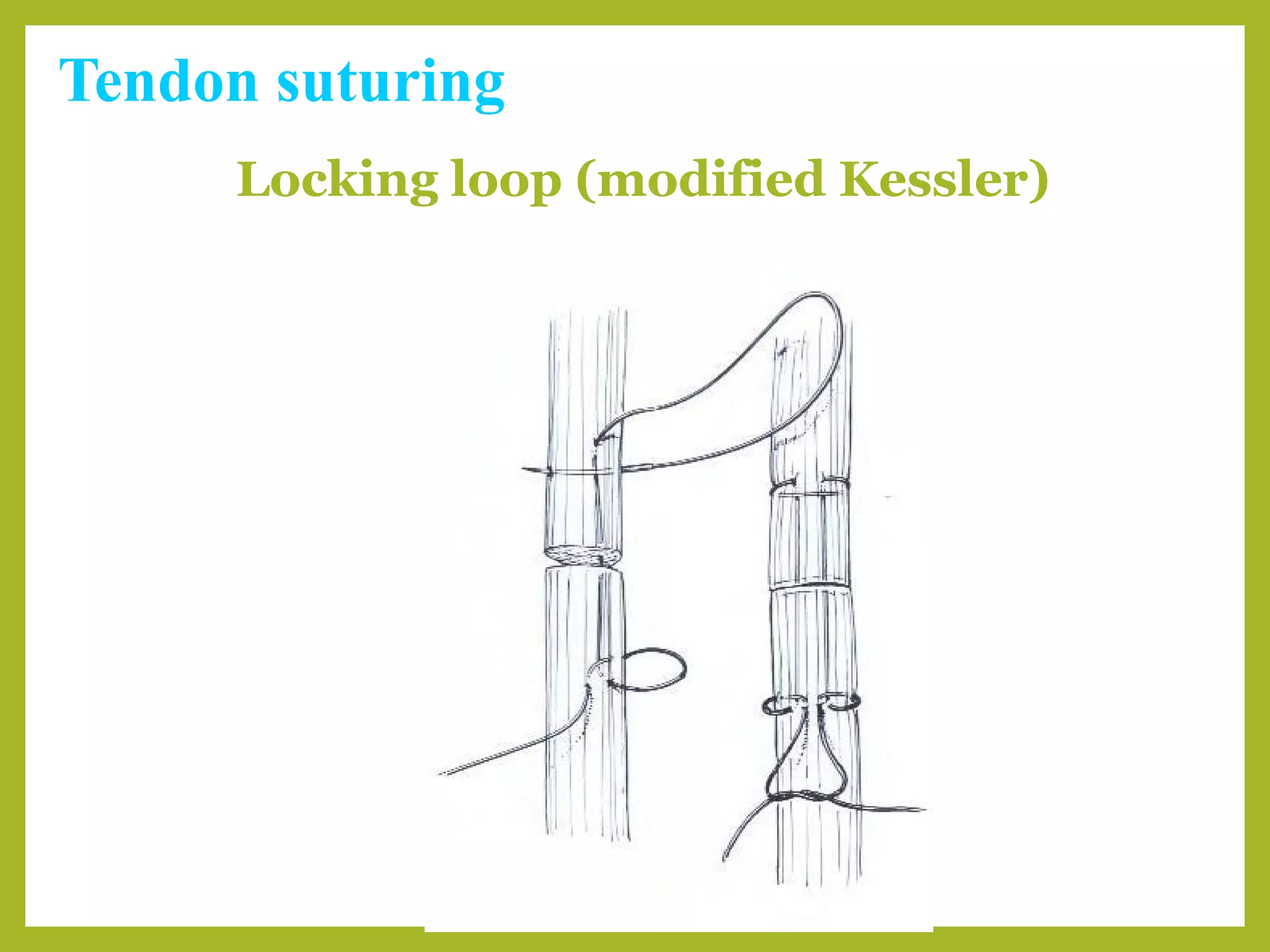 Tendon suturing
Locking loop (modified Kessler)
 