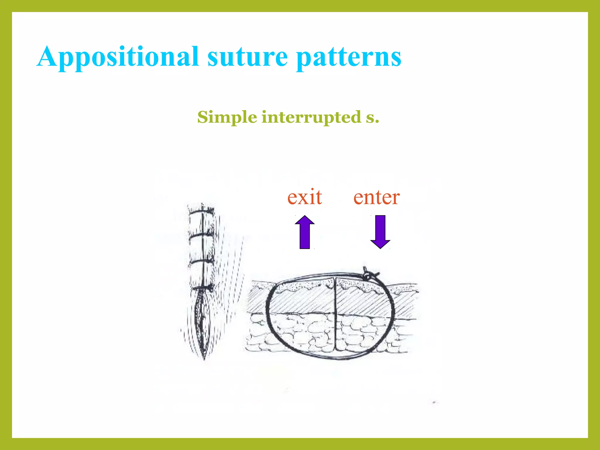 Appositional suture patterns
Simple interrupted s.
enterexit
 