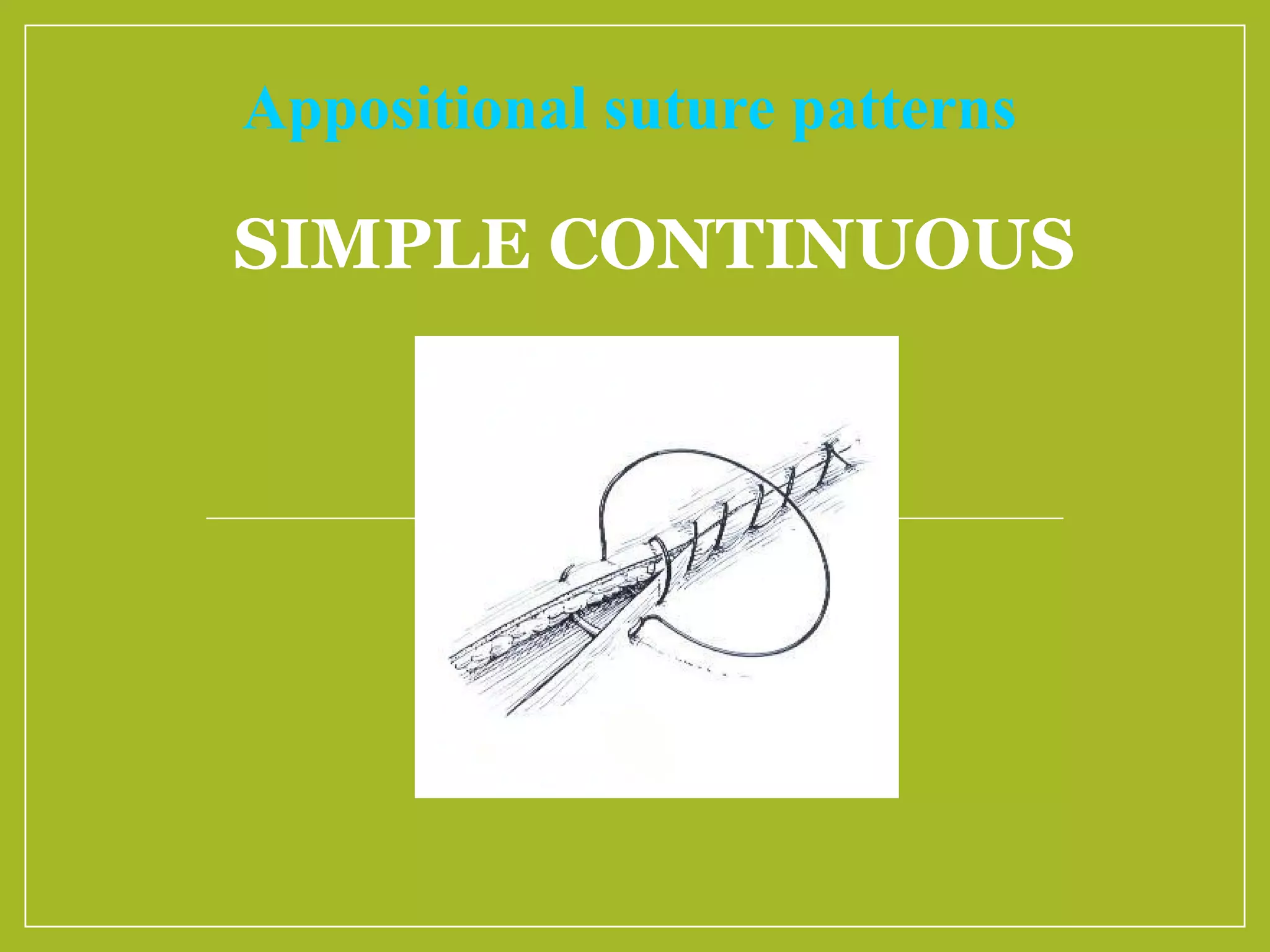 SIMPLE CONTINUOUS
Appositional suture patterns
 