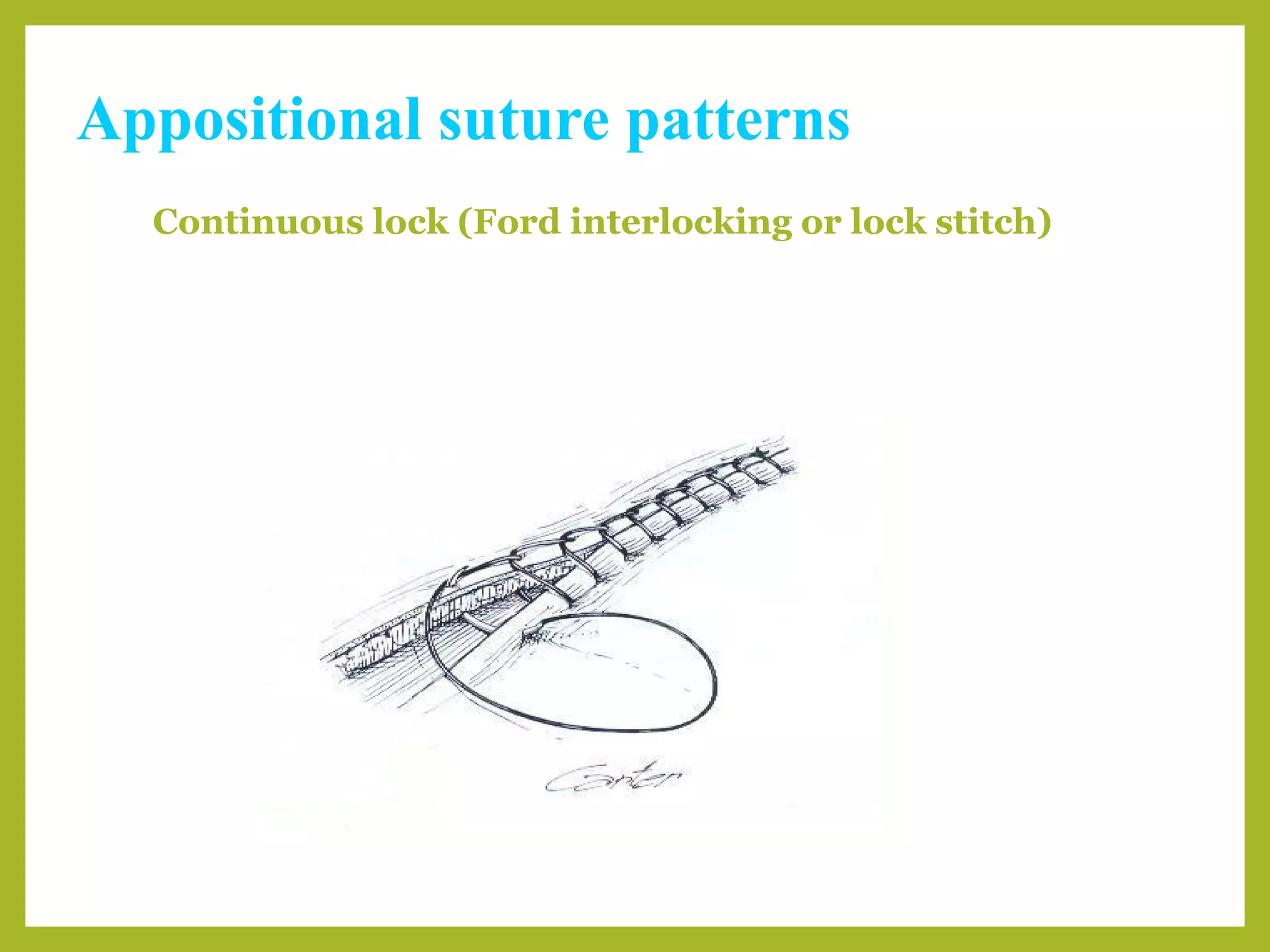 Appositional suture patterns
Continuous lock (Ford interlocking or lock stitch)
 