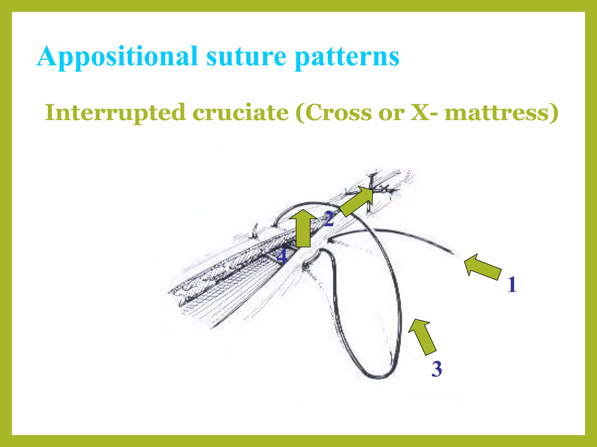 Appositional suture patterns
Interrupted cruciate (Cross or X- mattress)
1
2
3
4
 