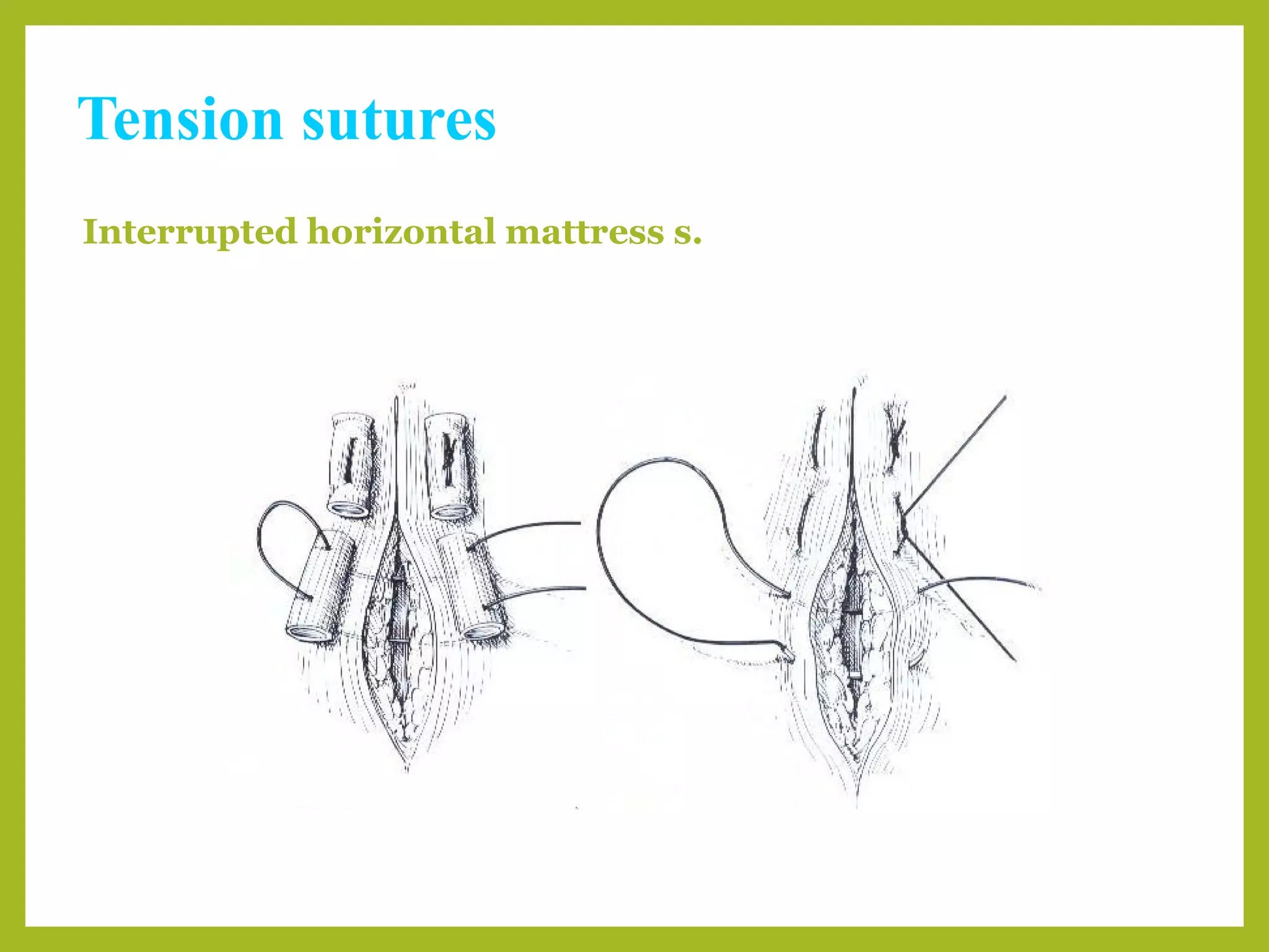 Tension sutures
Interrupted horizontal mattress s.
With stents Without stents
 