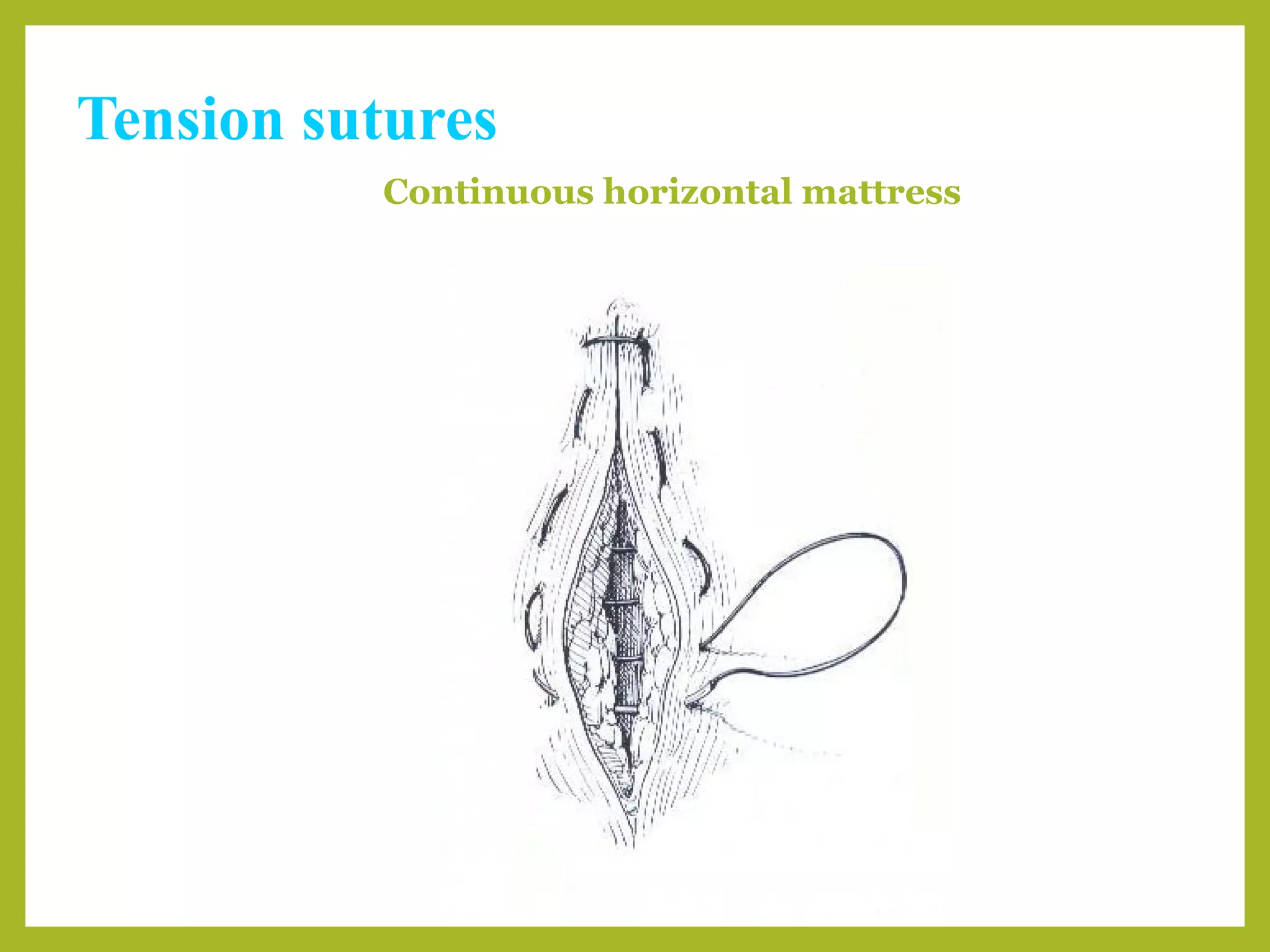 Tension sutures
Continuous horizontal mattress
 