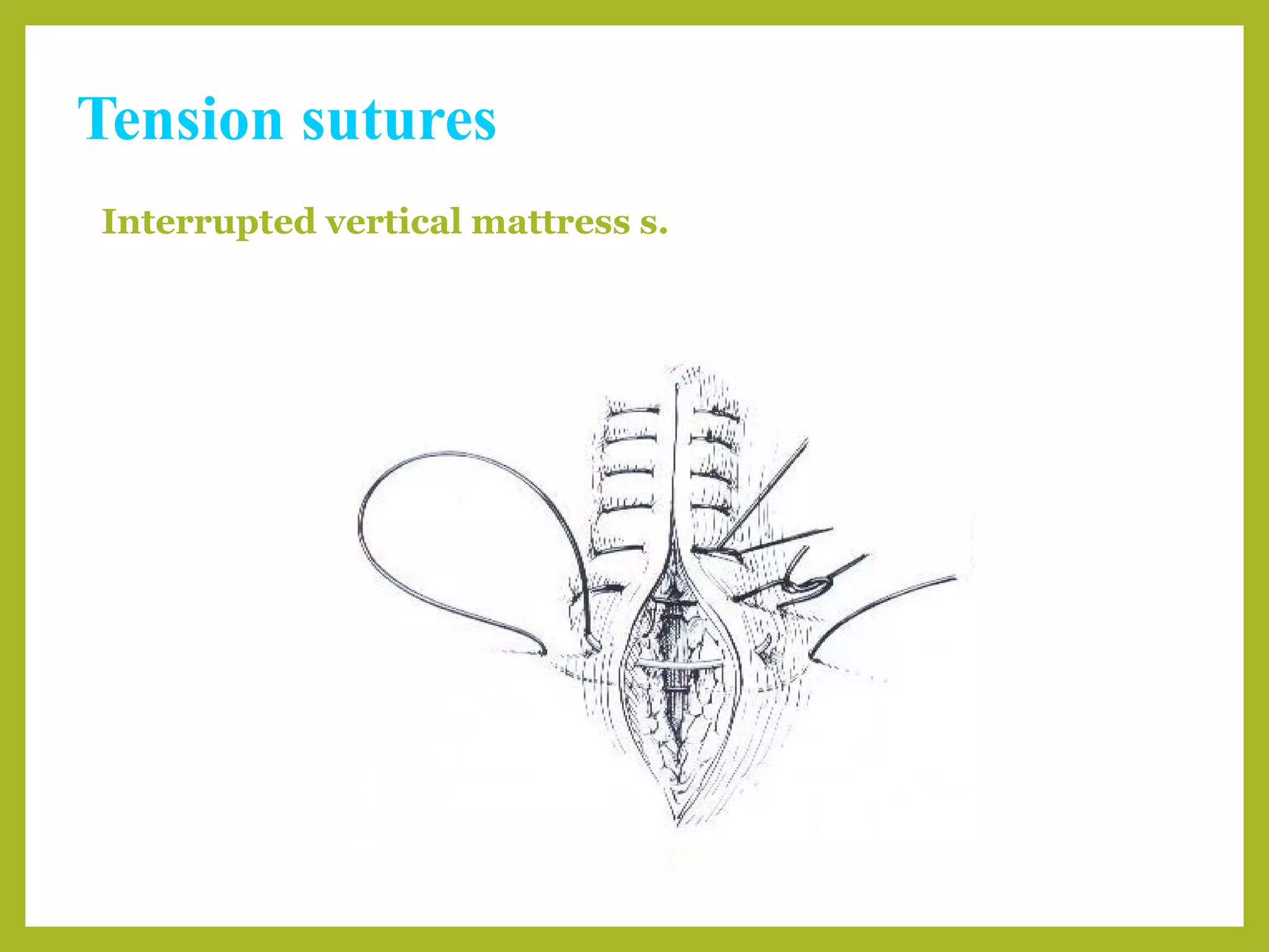 Tension sutures
Interrupted vertical mattress s.
 