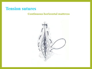 Basic suture patterns | PPT