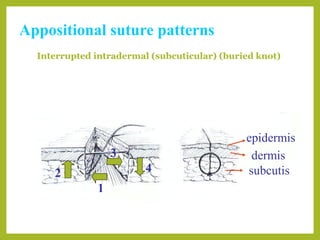 Common Suture Patterns