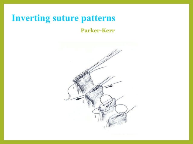 Basic suture patterns