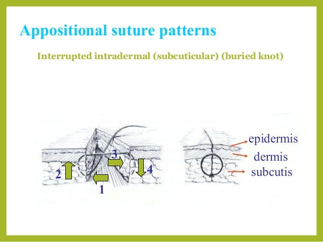 Basic suture patterns