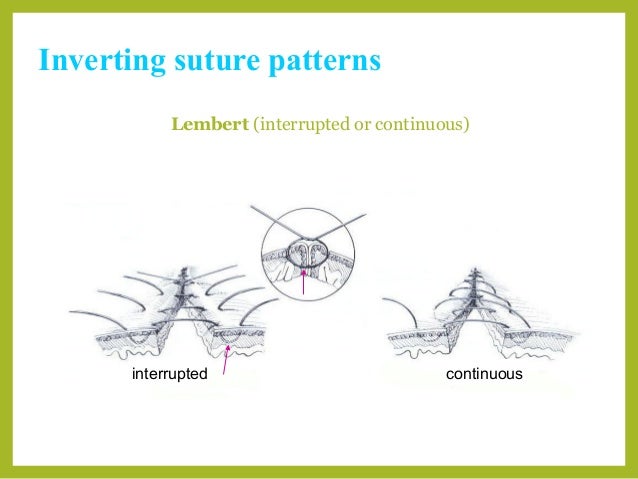 suture patterns