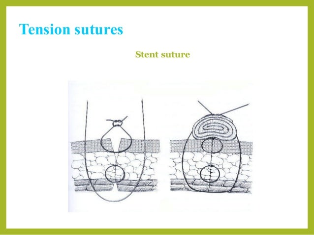 Basic suture patterns