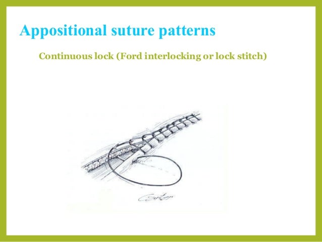 suture patterns