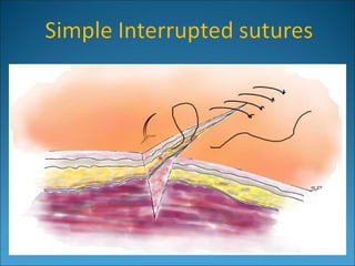 Basic Suturing Principles 2013 basic suturing .ppt