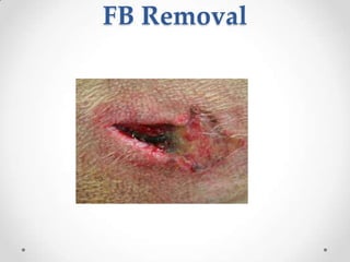 FB Removal
 