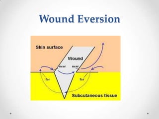 Wound Eversion
 