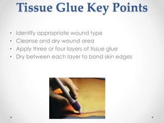 Tissue Glue Key Points
•   Identify appropriate wound type
•   Cleanse and dry wound area
•   Apply three or four layers of tissue glue
•   Dry between each layer to bond skin edges
 