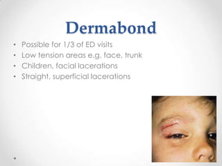 Dermabond
•   Possible for 1/3 of ED visits
•   Low tension areas e.g. face, trunk
•   Children, facial lacerations
•   Straight, superficial lacerations
 