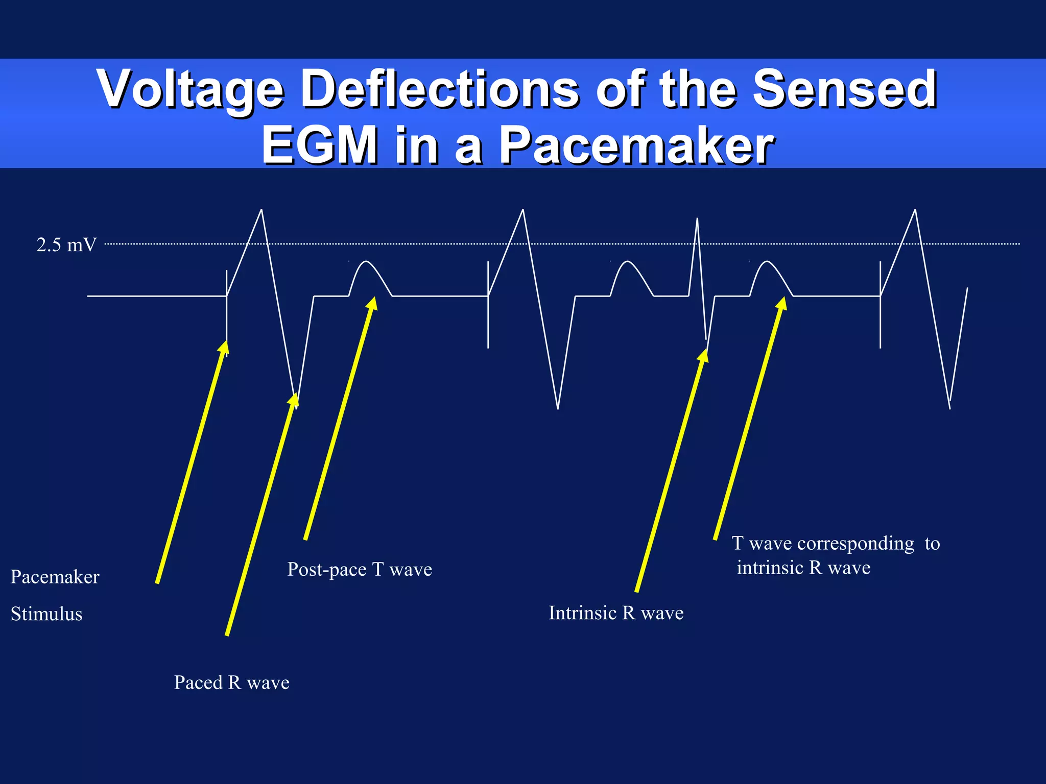 Voltage Deflections of the SensedVoltage Deflections of the Sensed
EGM in a PacemakerEGM in a Pacemaker
Pacemaker
Stimulus
Paced R wave
Post-pace T wave
Intrinsic R wave
T wave corresponding to
intrinsic R wave
2.5 mV
 