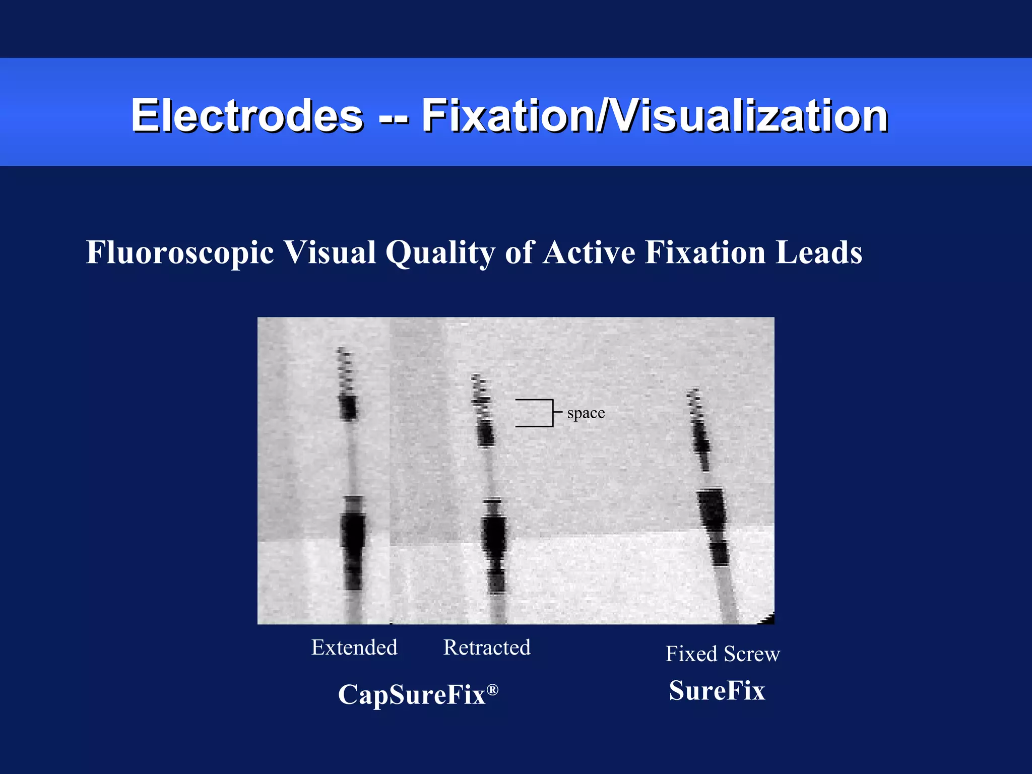 Electrodes -- Fixation/VisualizationElectrodes -- Fixation/Visualization
Fluoroscopic Visual Quality of Active Fixation Leads
SureFixCapSureFix®
Extended Retracted Fixed Screw
space
 