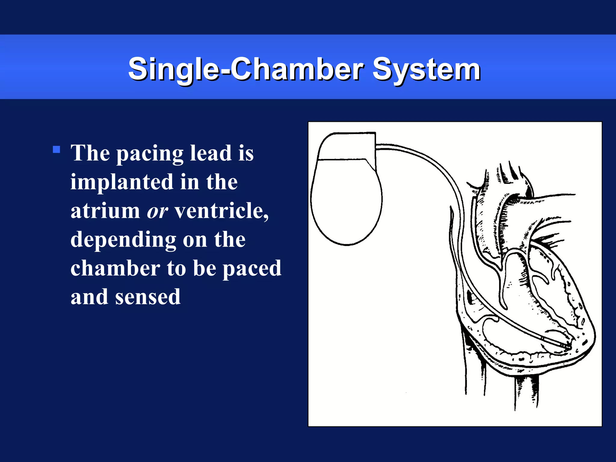 Single-Chamber SystemSingle-Chamber System
 The pacing lead is
implanted in the
atrium or ventricle,
depending on the
chamber to be paced
and sensed
 
