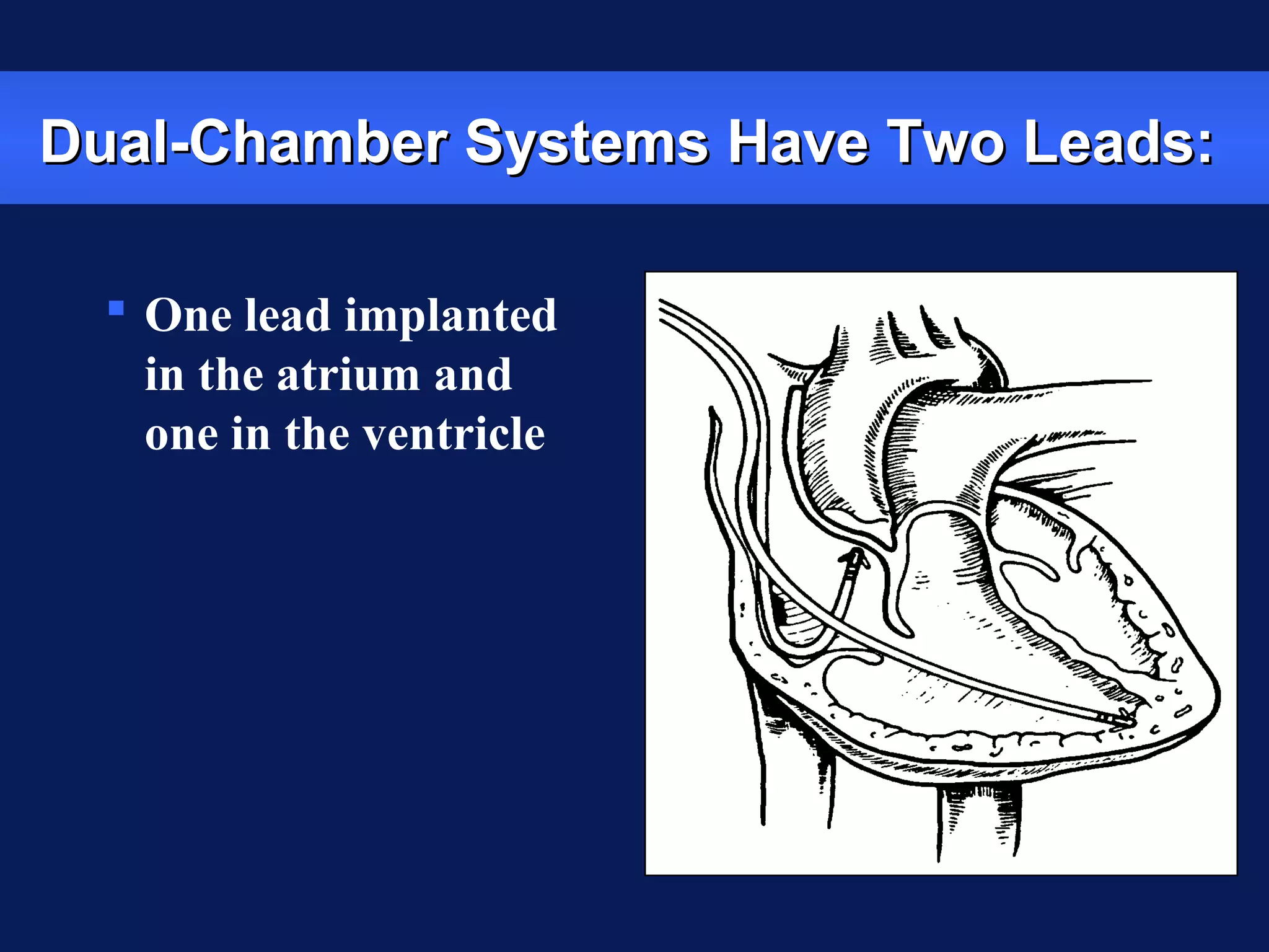  One lead implanted
in the atrium and
one in the ventricle
Dual-Chamber Systems Have Two Leads:Dual-Chamber Systems Have Two Leads:
 