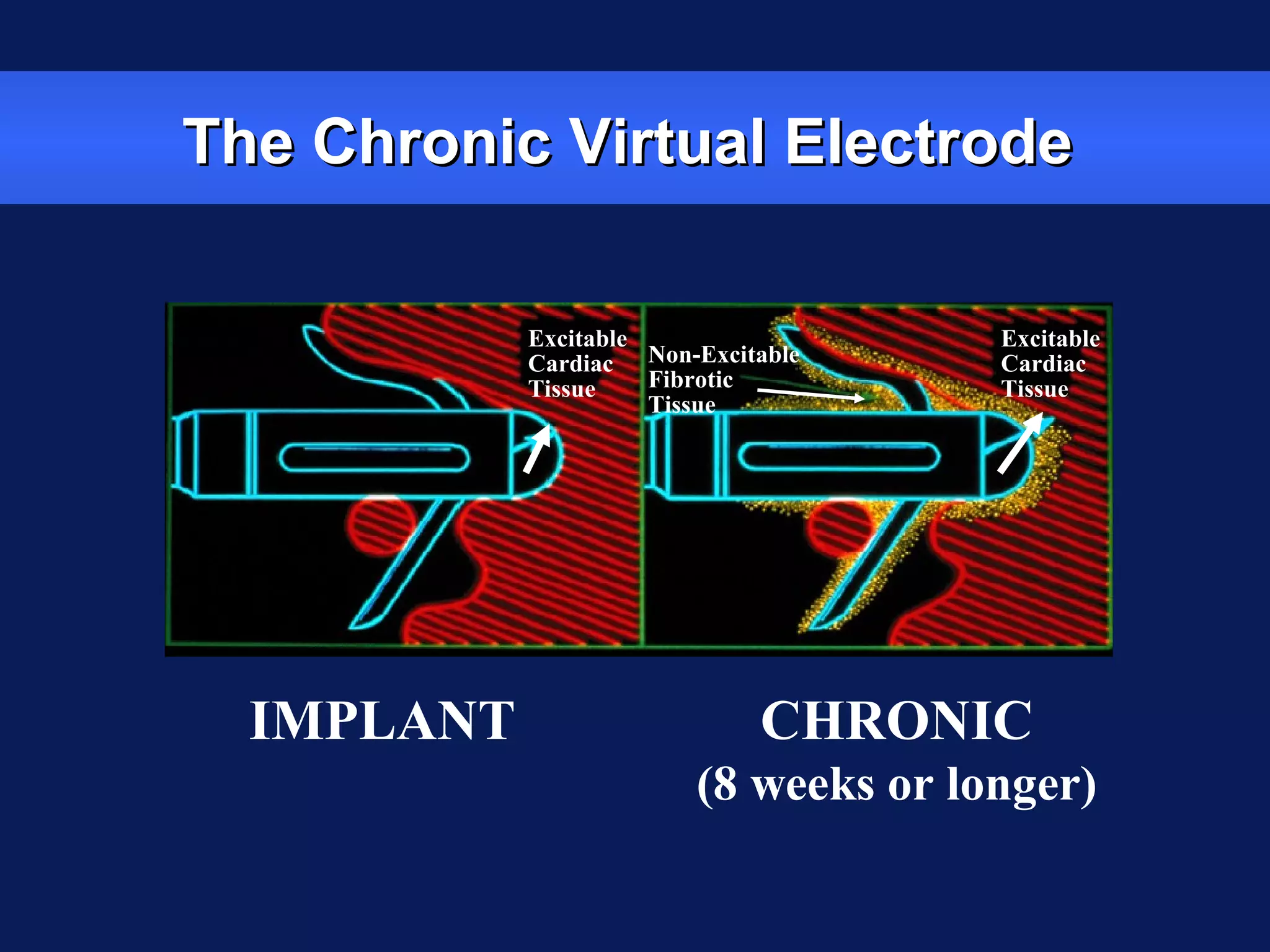 The Chronic Virtual ElectrodeThe Chronic Virtual Electrode
IMPLANT CHRONIC
(8 weeks or longer)
Excitable
Cardiac
Tissue
Non-Excitable
Fibrotic
Tissue
Excitable
Cardiac
Tissue
 