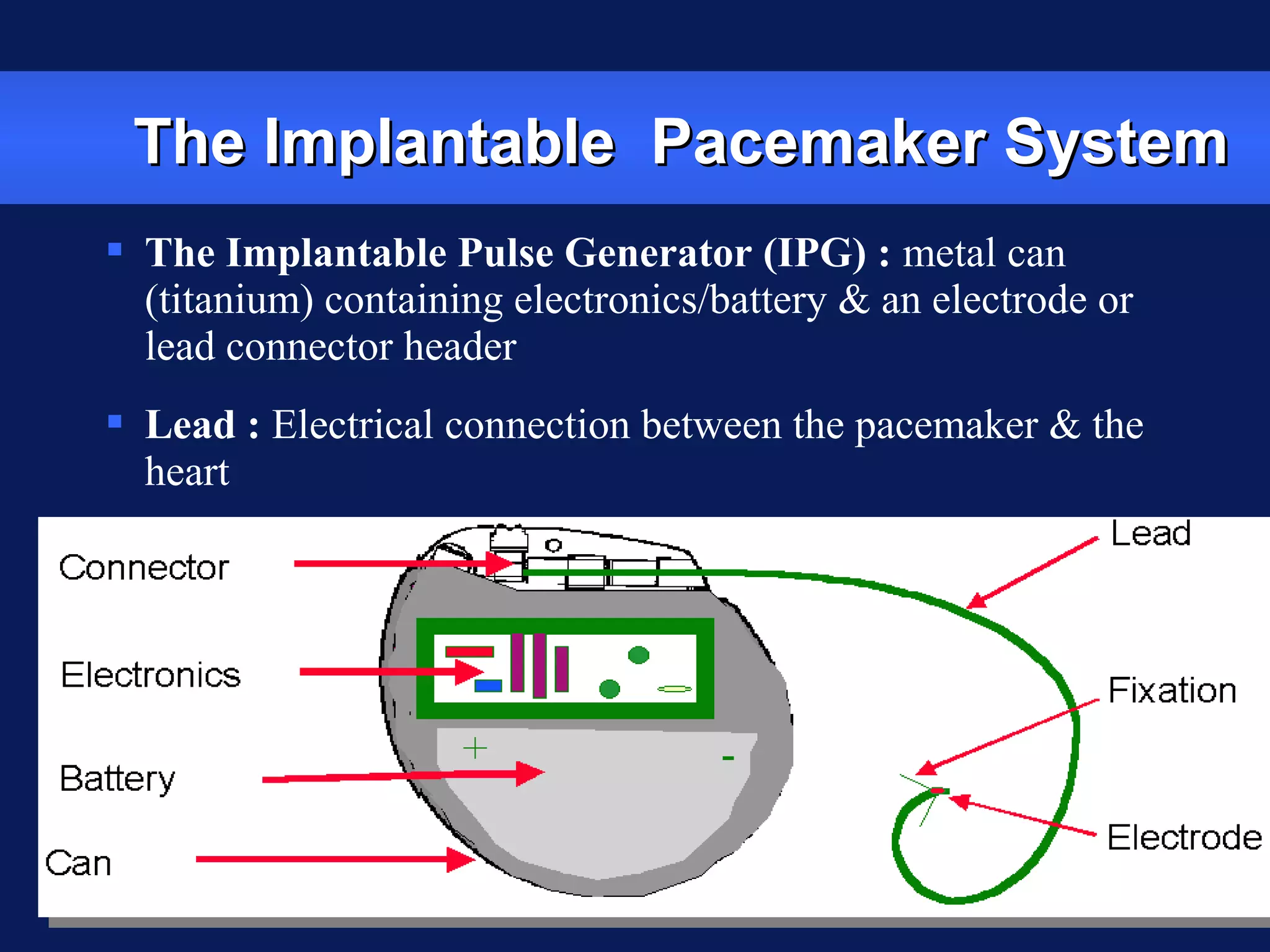 The Implantable Pacemaker SystemThe Implantable Pacemaker System
 The Implantable Pulse Generator (IPG) : metal can
(titanium) containing electronics/battery & an electrode or
lead connector header
 Lead : Electrical connection between the pacemaker & the
heart
 